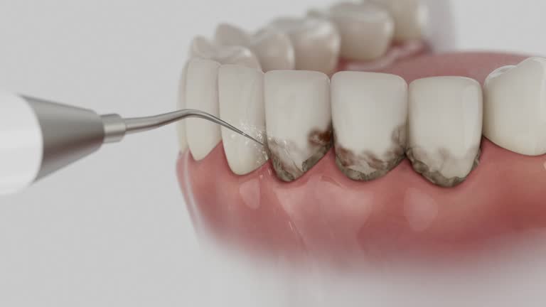 Trusted Dental Crowns And Bridges service in Clendenin, WV - Dentist Open Now
